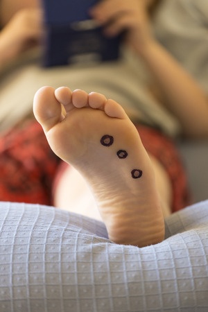 wart on foot black dots)